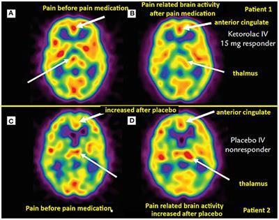 Utility of SPECT Functional Neuroimaging of Pain